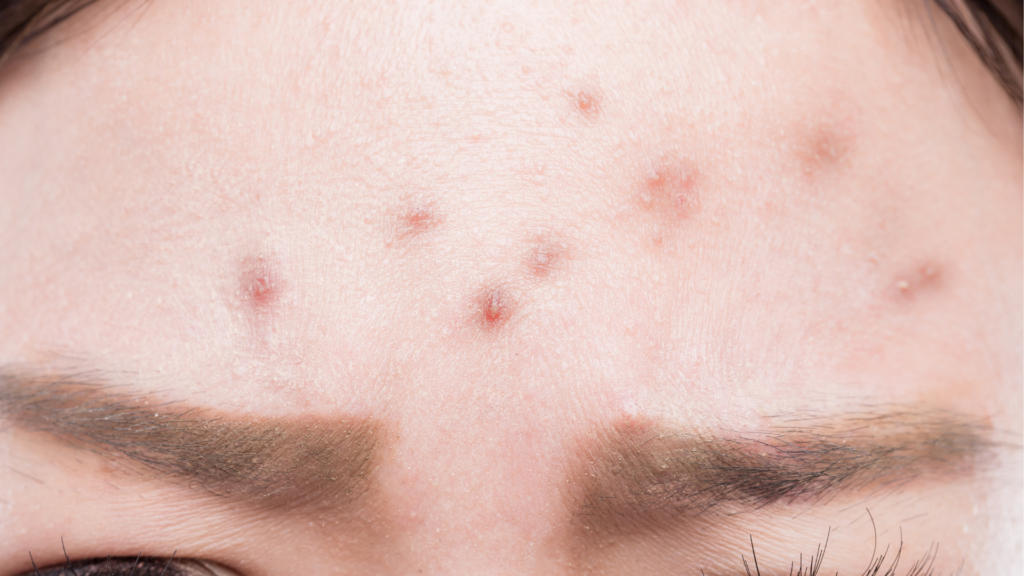Why Is Your Forehead Breaking Out Forehead Acne Explained Bullets